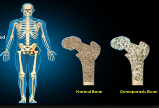 Kalsiyum Birikmesi Nasıl Anlaşılır?