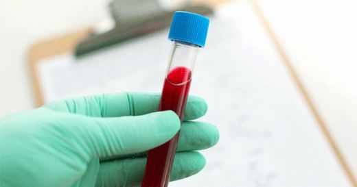 Kalsiyum Düşüklüğü Belirtileri ve Tedavisi