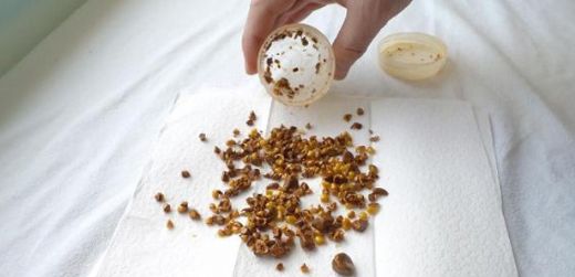 Kalsiyum Oksalat Taşı Tedavisi